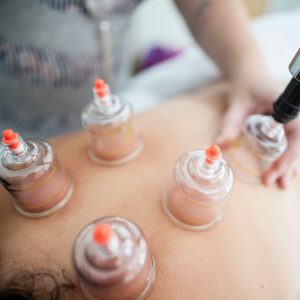 cupping_theraphy