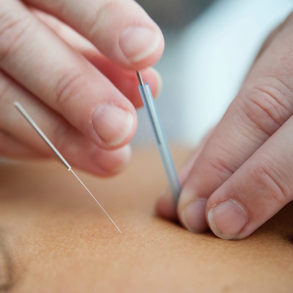 acupucture needles are applied by hands